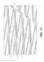 Fig. 11 - Implantable stent