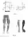 Fig. 06 - Knee brace and system for custom fabricating knee brace for a user