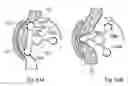 Fig. 33 - Method for controlling flow of sperms in a uterine tube