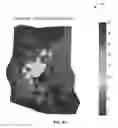 Fig. 09 - Detection and localization of cardiac fast firing
