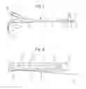 Fig. 02 - SENSING A PROPERTY OF A BLADDER WALL