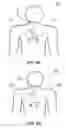 Fig. 06 - Thoracic garment of positioning electromagnetic (EM) transducers and methods of using such thoracic garment