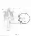 Fig. 09 - Externally placed electromagnetic fiducial element