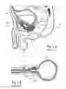Fig. 02 - Devices, systems and methods for treating benign prostatic hyperplasia and other conditions