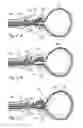 Fig. 03 - Devices, systems and methods for treating benign prostatic hyperplasia and other conditions