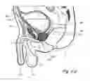 Fig. 06 - Devices, systems and methods for treating benign prostatic hyperplasia and other conditions