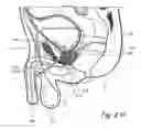 Fig. 07 - Devices, systems and methods for treating benign prostatic hyperplasia and other conditions