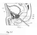 Fig. 08 - Devices, systems and methods for treating benign prostatic hyperplasia and other conditions