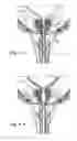 Fig. 14 - Devices, systems and methods for treating benign prostatic hyperplasia and other conditions