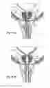 Fig. 15 - Devices, systems and methods for treating benign prostatic hyperplasia and other conditions