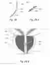 Fig. 40 - Devices, systems and methods for treating benign prostatic hyperplasia and other conditions