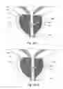 Fig. 41 - Devices, systems and methods for treating benign prostatic hyperplasia and other conditions