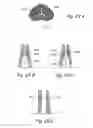 Fig. 43 - Devices, systems and methods for treating benign prostatic hyperplasia and other conditions