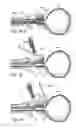 Fig. 45 - Devices, systems and methods for treating benign prostatic hyperplasia and other conditions