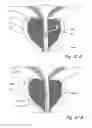 Fig. 52 - Devices, systems and methods for treating benign prostatic hyperplasia and other conditions