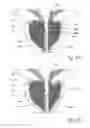Fig. 57 - Devices, systems and methods for treating benign prostatic hyperplasia and other conditions