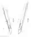 Fig. 15 - Minimally-invasive tissue suturing device