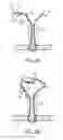 Fig. 03 - KNOTLESS COLLAPSIBLE SUTURES AND METHODS FOR SUTURING
