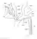 Fig. 01 - Method of use for an arm access arch fulcrum support catheter