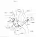 Fig. 07 - Method of use for an arm access arch fulcrum support catheter