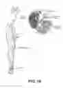 Fig. 14 - Percutaneous lead placement assembly