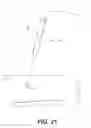 Fig. 18 - Percutaneous lead placement assembly