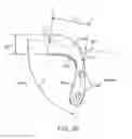 Fig. 06 - Method and apparatus for altering biomechanics of the shoulder