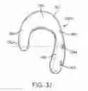 Fig. 10 - Method and apparatus for altering biomechanics of the shoulder