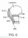 Fig. 12 - Method and apparatus for altering biomechanics of the shoulder