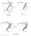 Fig. 19 - Method and apparatus for altering biomechanics of the shoulder