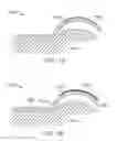 Fig. 22 - Method and apparatus for altering biomechanics of the shoulder
