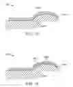Fig. 23 - Method and apparatus for altering biomechanics of the shoulder