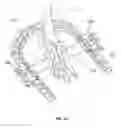 Fig. 30 - External fixator system