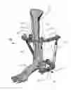 Fig. 01 - External fixation for the correction of bone deformity and trauma