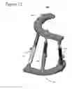 Fig. 13 - External fixation for the correction of bone deformity and trauma
