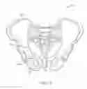 Fig. 02 - Shape adaptable intramedullary fixation device