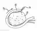 Fig. 01 - Method and system for providing a suture wrap cerclage