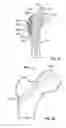 Fig. 44 - Fixation systems and methods