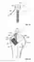 Fig. 58 - Fixation systems and methods