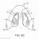 Fig. 04 - Methods and devices to treat nasal airways