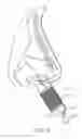 Fig. 08 - Methods and devices to treat nasal airways