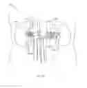 Fig. 11 - Intravascular energy delivery