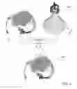 Fig. 02 - Method for virtual device positioning on skin surface in 3D medical image data