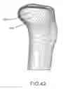 Fig. 65 - Arthroplasty jigs with mating accuracy