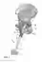 Fig. 02 - ACETABULAR CUP IMPACTING USING PATIENT-SPECIFIC INSTRUMENTATION