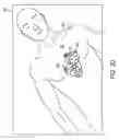 Fig. 06 - Augmented reality device for providing feedback to an acute care provider