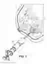 Fig. 02 - Biopsy site marker