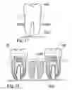 Fig. 10 - Methods of designing and manufacturing customized dental prosthesis for periodontal or osseointegration and related systems