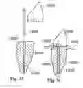 Fig. 18 - Methods of designing and manufacturing customized dental prosthesis for periodontal or osseointegration and related systems
