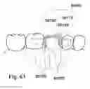 Fig. 42 - Methods of designing and manufacturing customized dental prosthesis for periodontal or osseointegration and related systems